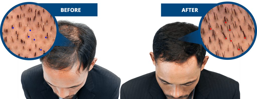 profollica before and after results